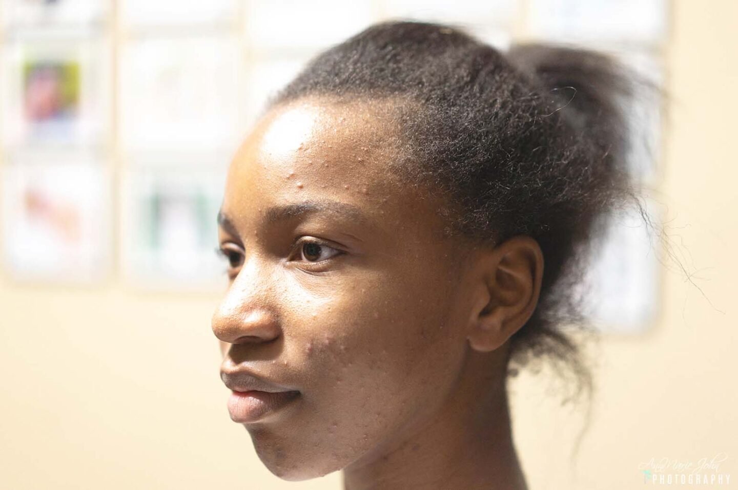 5 Acne Prevention And Management Tips For A Smooth And Glowing Skin