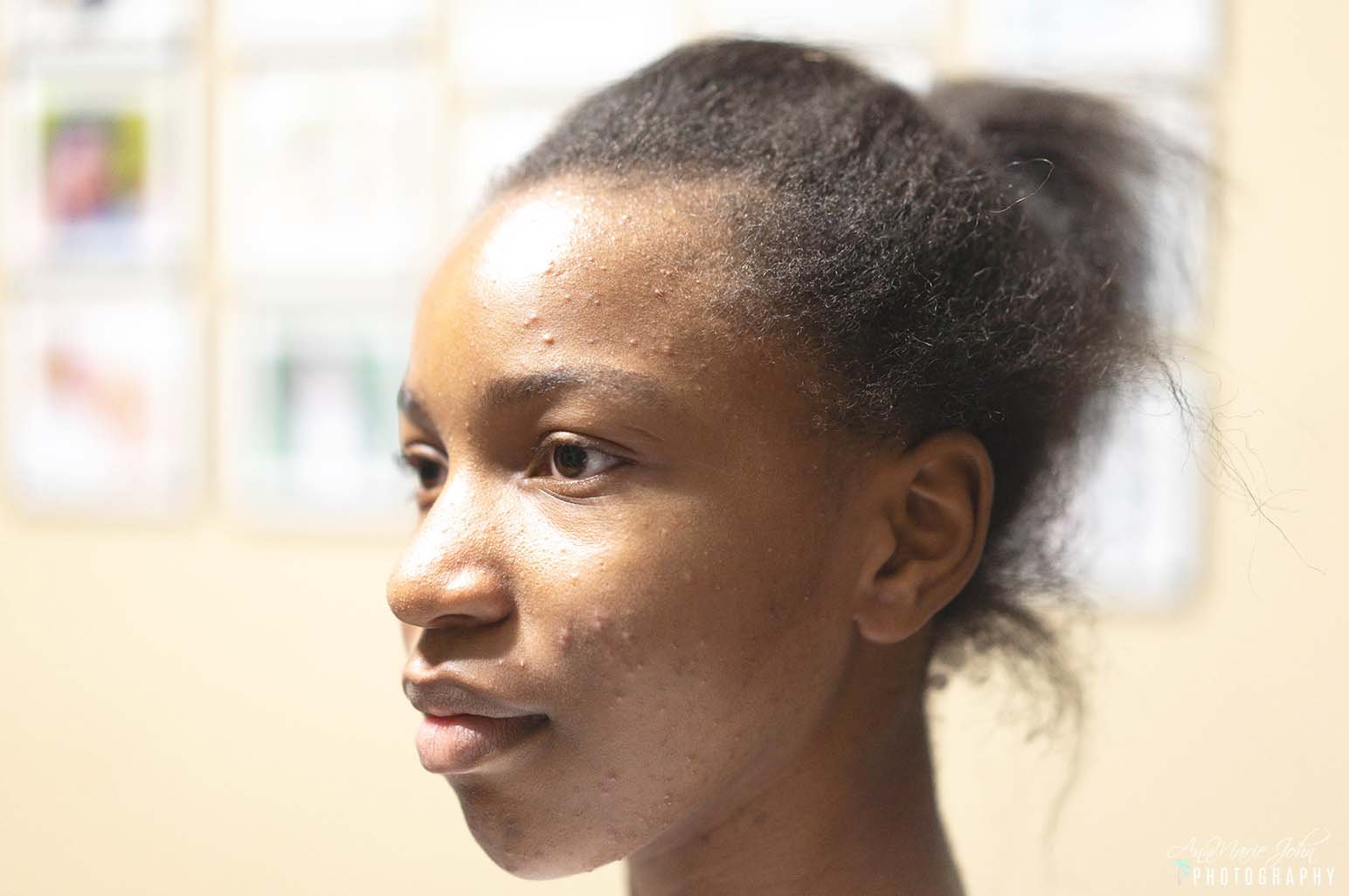 5 Acne Prevention And Management Tips For A Smooth And Glowing Skin